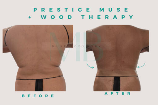 Body Sculpting Body Sculpting